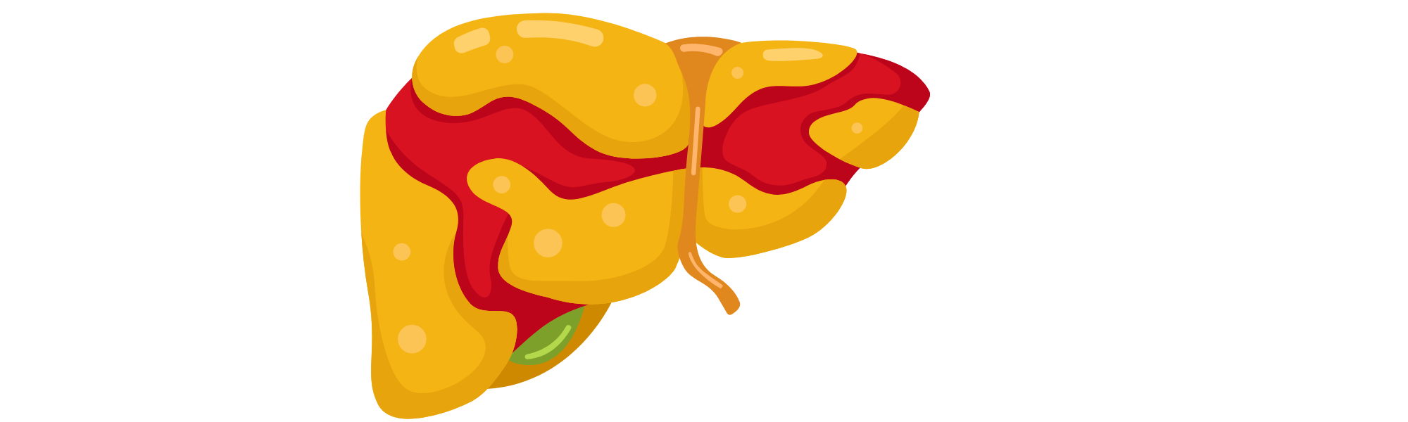 Fatty Liver Disease: The Silent Threat Affecting Millions