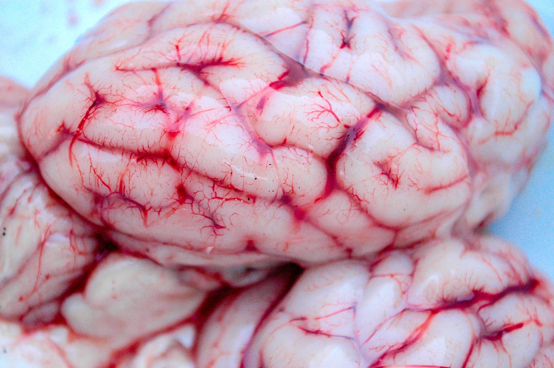The Link Between Inflammation, Food, and Brain Damage Leading to Alzheimer’s and Parkinson’s